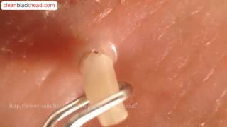 Blackhead Removal Tool  Popping Whiteheads and Blackheads Close Up [upl. by Flieger]