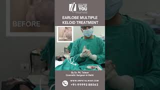 Multiple Keloid Treatment  Ear Keloid Treatment in Delhi  Dr PK Talwar [upl. by Syverson]