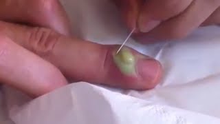 Paronychia What are nail infections paronychia and nail popping [upl. by Cahan]