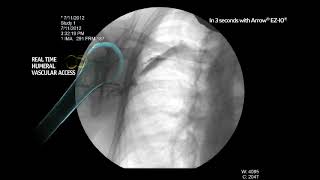 Arrow® EZIO® System  Proximal Humerus Infusion Fluoroscopy Adult Alert Patient [upl. by Strickland]