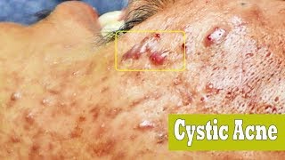 Extraction et drainage kyste enflammé  cystic acne [upl. by Edlyn96]