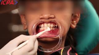 The Best Technique to Apply Fluoritop Varnish in Children [upl. by Eirollam]