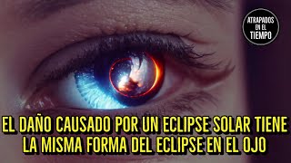 El daño causado por un eclipse solar tiene la misma forma del eclipse en el ojo eclipse [upl. by Erie]