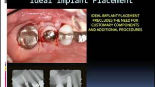 Formula for the Perfect Implant Placement [upl. by Alieka534]