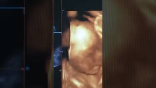 3D Ultraschall von Baby im Mutterleib [upl. by Paulette]