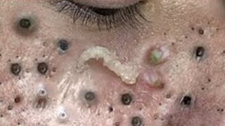 Big Cystic Acne Blackheads Extraction Blackheads amp Milia Whiteheads Removal Pimple Popping  3845 [upl. by God]