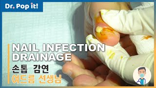 Paronychia aka a nail infection drainage  Dr Pop It [upl. by Welcy]