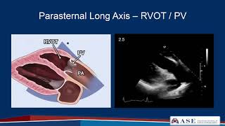 Part 2 Comprehensive TTE in Adults Webinar [upl. by Chap]