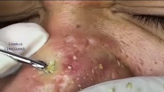 Acne Treatment Blackhead Removal on his nose Remove Blackhead removeblackhead [upl. by Blockus73]