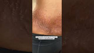 Solution for stretch marks on the side [upl. by Carrington]