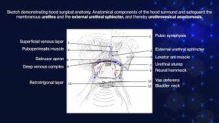 Hood Technique for Robotic Radical Prostatectomy [upl. by Yllehs741]