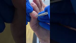 Effective Removal of Painful Little Toe Corn by Australian Podiatrist  Corn and Callus Relief [upl. by Efren]