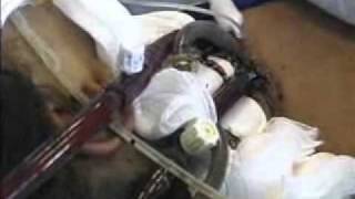 Extracorporeal Membrane Oxygenation ECMO [upl. by Clarey706]