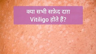 क्या सभी सफ़ेद दाग़ Vitiligo होते हैं Vitiligo Leucoderma P alba P versicolor Leprosy Nevus [upl. by Baptist]