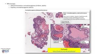 Brain Craniopharyngioma suprasellar tumour [upl. by Abbotson]