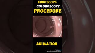 Colonoscopy [upl. by Burnham]