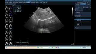 IQ 276 TFAST LUNG MASS ULTRASOUND ECHOPAC ANALYSIS 3 4 [upl. by Shields]