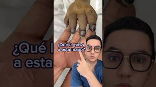 ¿Qué le pasó a esta mano Acrocianosis Dr William Guerrero medicina shorts [upl. by Znarf]