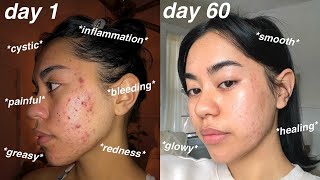 I CLEARED MY ACNE 60 days using Differin Gel Adapalene 01  pictures [upl. by Valiant654]