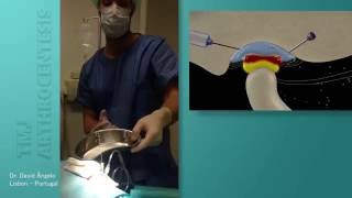 Dr David Ângelo explains TMJ Arthrocentesis Lysis and Lavage Technique [upl. by Arras871]