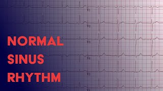 Normal Sinus Rhythm  EKG ECG Interpretation [upl. by Atalaya]