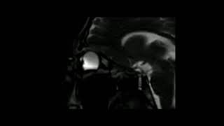 Keratoconus Eye rubbing MRI Keratocone frottements oculaires IRM [upl. by Bergeman]