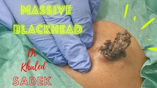 Massive 15 year Blackhead Dr Khaled Sadek LipomaCystcom [upl. by Carlson327]