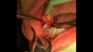 4 Wisdom Teeth Removal Surgery [upl. by Aizitel]