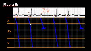 CURSO DE ELECTROCARDIOGRAFIA 40  BLOQUEO AV DE SEGUNDO GRADO [upl. by Neenaej]