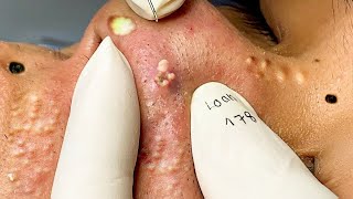 Big Cystic Acne Blackheads Extraction Blackheads amp Milia Whiteheads Removal Pimple Popping  9172 [upl. by Andris]