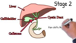 Cholecystitis  Symptoms Causes Treatment How to Detect Cholecystitis Merphy sign Explained Easy [upl. by Trebeh]