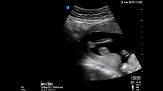 Ultrasound for Trauma in Pregnancy [upl. by Enomor297]