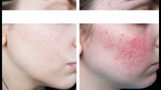 Tout sur ma Rosacée  Kératose pilaire  Session Laser  Dr Charbonneau [upl. by Attiuqal]