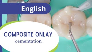 Composite onlay  part 5 final cementation [upl. by Wellington239]