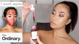 The Ordinary Peeling Solution  1 Month Use [upl. by Shayna594]