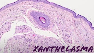 Xanthelasma xanthoma of eyelid yellow bumps around eye pathology dermpath dermatology [upl. by Eednas]