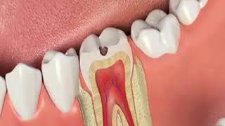 Avoid Rootcanal therapy with Indirect Pulp capping [upl. by Garling635]