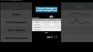 P Wave Changes in Atrial Enlargement [upl. by Bultman997]