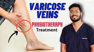 Varicose veins Physiotherapy Treatment  Varicose veins problem Hindi [upl. by Isiad595]