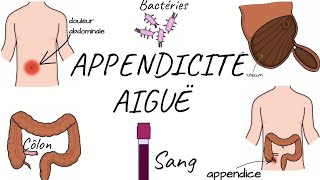 LAPPENDICITE AIGUË physiopathologie symptômes diagnostic traitement [upl. by Anitnegra376]