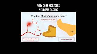 Why does Mortons neuroma occur morton neuroma inflammation nervepainrelief [upl. by Diskson]