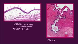 Chronic cholecystitis causes symptoms diagnosis treatment amp pathology [upl. by Daven]