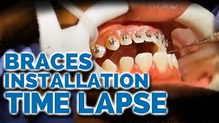 Braces Installation Time Lapse What to expect when getting braces [upl. by Haroldson198]