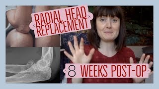 Radial head replacement surgery 8 weeks postop [upl. by Jerrol]