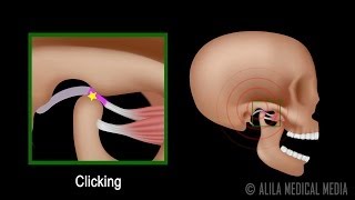 Temporomandibular Joint TMJ Anatomy and Disc Displacement Animation [upl. by Royo]