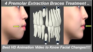 Changes in Face After 4 1st Premolars Extraction amp Braces Treatment Best HD Animation  Dr Ram MDS [upl. by Suzanne]