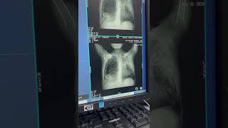 HRCT LUNGS SCANNING 🫁 [upl. by Golden]