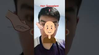 Hair transplant stickman animation [upl. by Irelav]