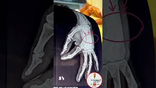 Metacarpal fractureहथेली के हड्डी मै तारDr Irfan Siddiqui orthopaedicbestbone anatomyfracture [upl. by Siurad]