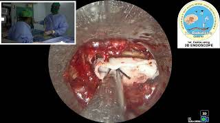 Rt L5S1 endo discectomy [upl. by Oker]